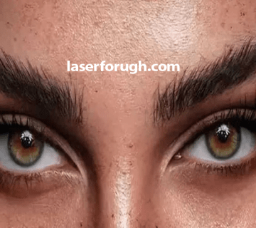 بوتاکس چشم گربهای در شهرکرد