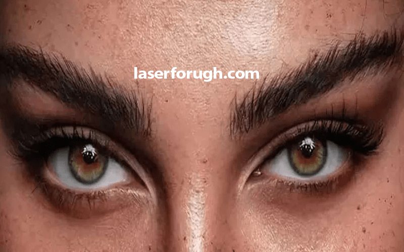 بوتاکس چشم گربه‌ای در شهرکرد